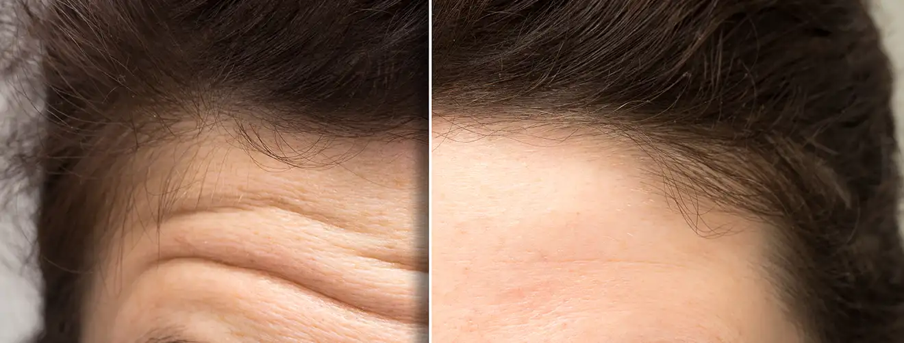 botax-treatment-image-before-after-image-01-novelage-01