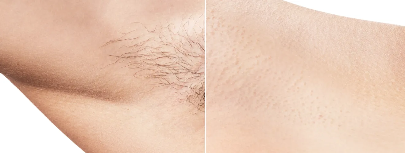 laser-hair-before-after-novelage-01