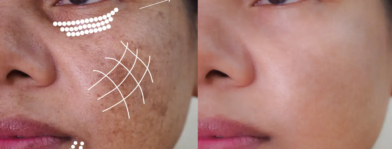 Pigmentation-treatment-novelage-services-image-02
