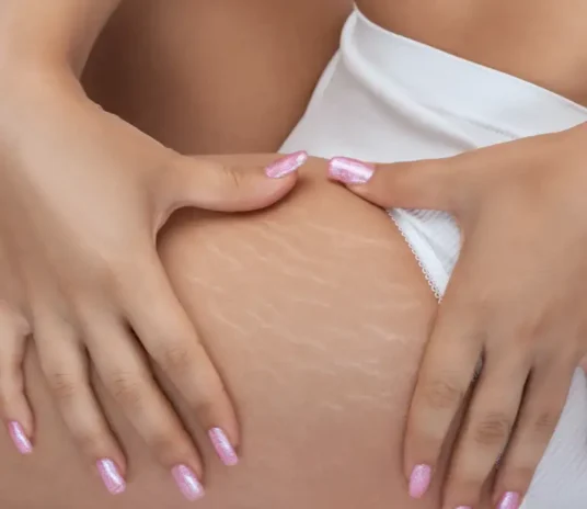 Stretch-marks-treatment-novelage-services-image-02