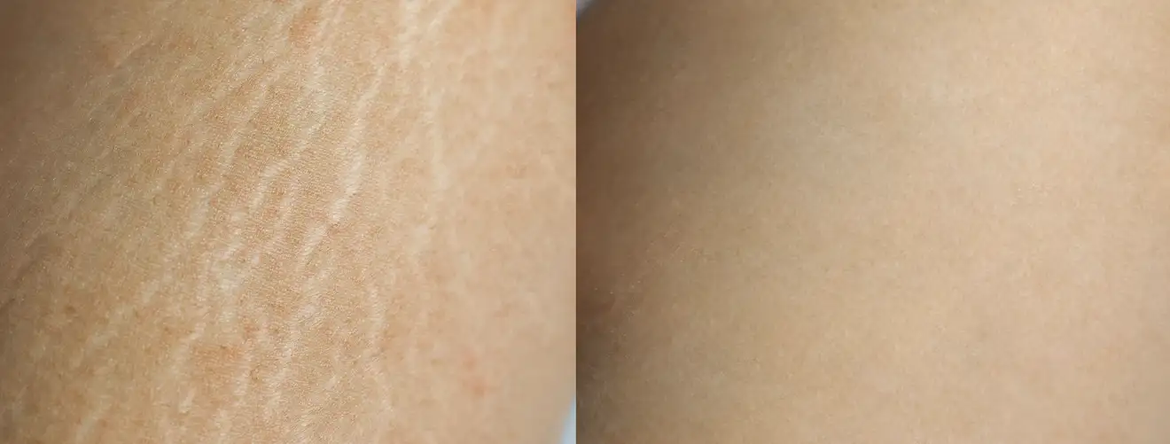 Stretch-marks-treatment-novelage-services-image-03