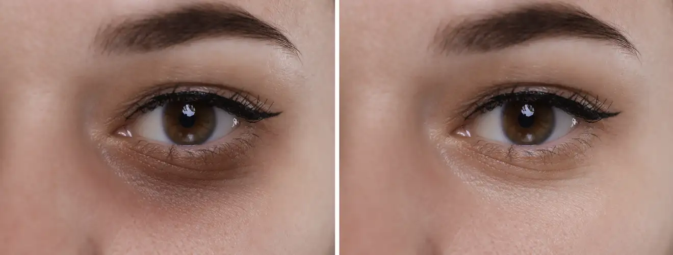 under-eye-treatment-novelage-services-image-02