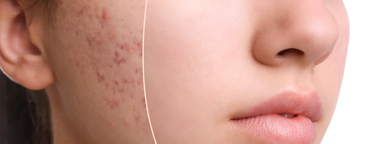 Acne-treatment-novelage-services-image-02