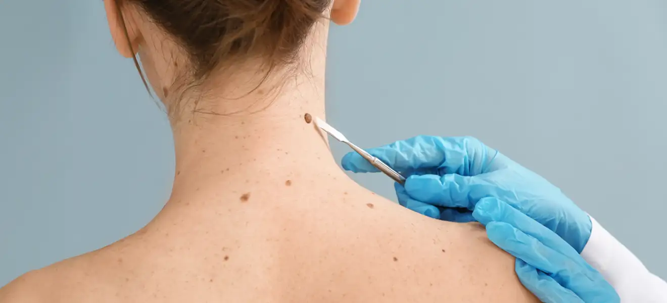 Warts-Moles-Skin-Tag Removal-treatment-novelage-services-image-01