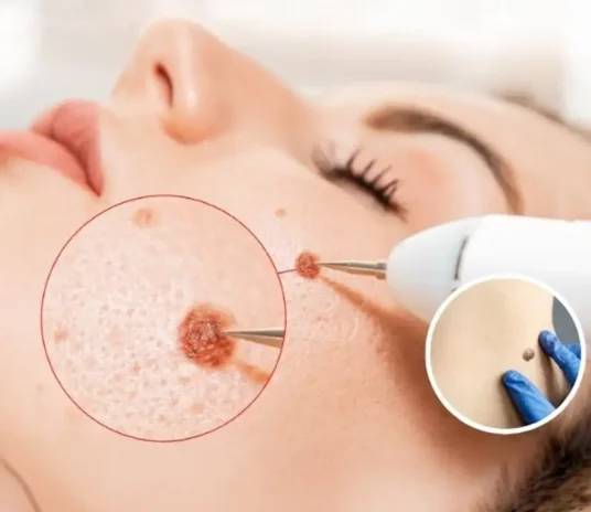 Warts-Moles-Skin-Tag Removal-treatment-novelage-services-image-02