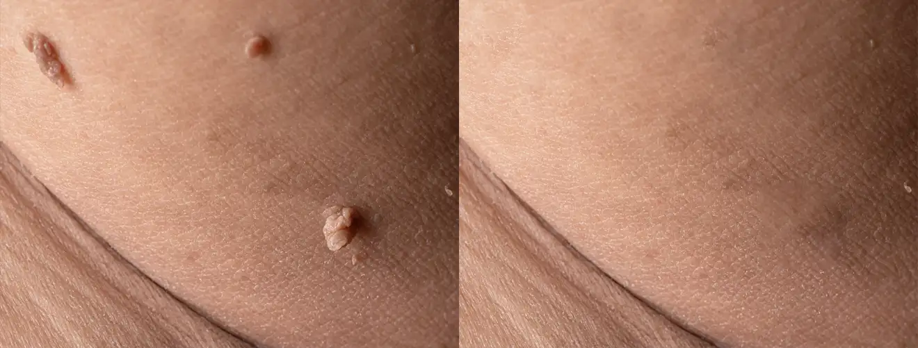 Warts-Moles-Skin-Tag Removal-treatment-novelage-services-image-03
